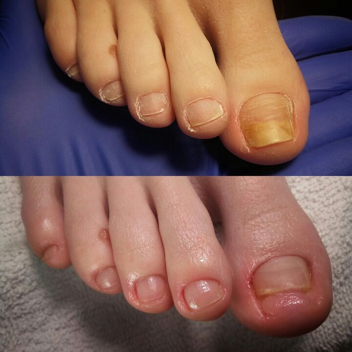 Prima e dopo aver applicato la crema brand esodermin cr.