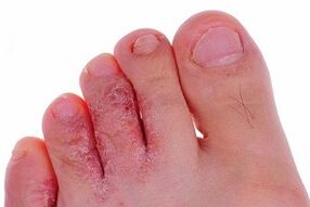 fungo sulle dita dei piedi